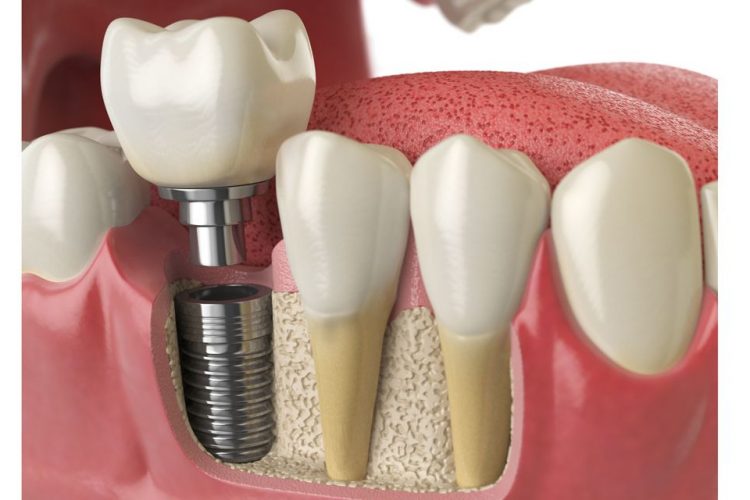 ایمپلنت دندان چیست | مزیت های ایمپلنت های دندانی | دکتر واحدی فردیس کرج