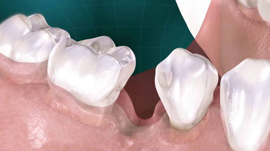 مشکلات دندان از دست رفته و اهمیت جایگزینی دندان | دندانپزشکی دکتر واحدی فردیس کرج