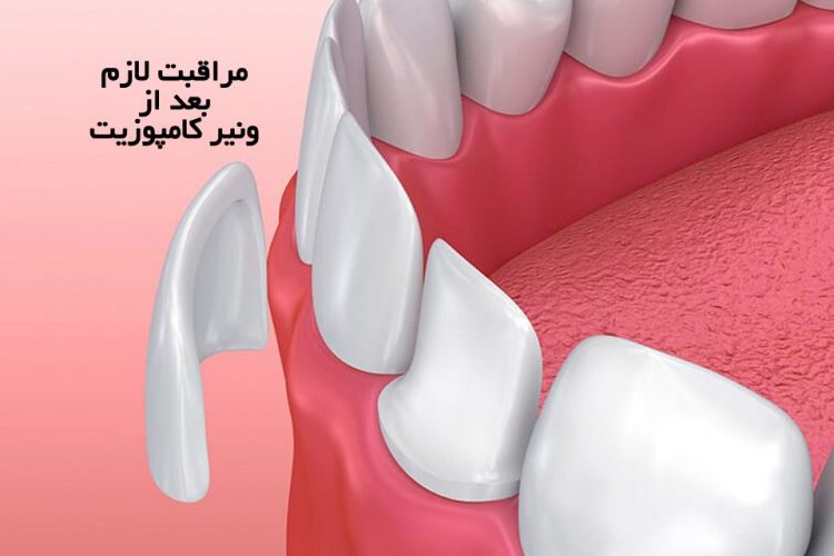 مراقبت های لازم بعد از ونیر كامپوزیت | مرکز دندانپزشکی دکتر رضا واحدی در فردیس کرج | مراقبت های بعد از کامپوزیت ونیر دندان