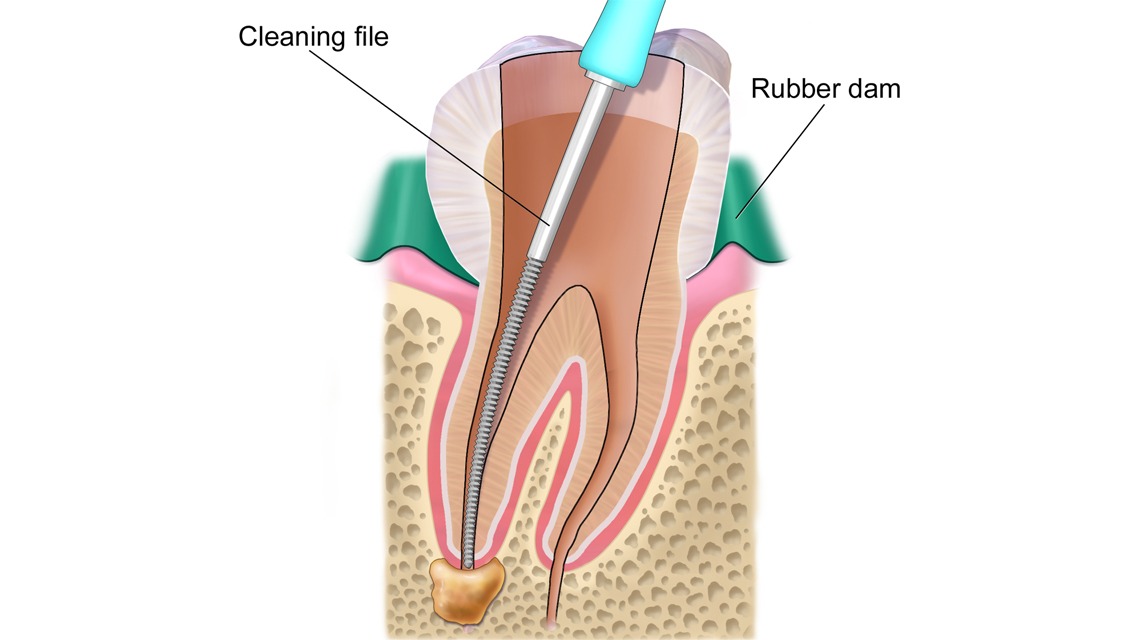 درمان ریشه | متخصص عصب کشی در فردیس کرج دکتر رضا واحدی | عصب کشی مجدد | درمان ریشه در اندیشه و شهریار | دندانپزشک درمان ریشه دندان